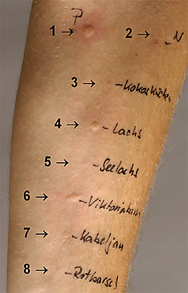 Pricktest/ Foto: Marcus Karsten/Uniklinik Leipzig